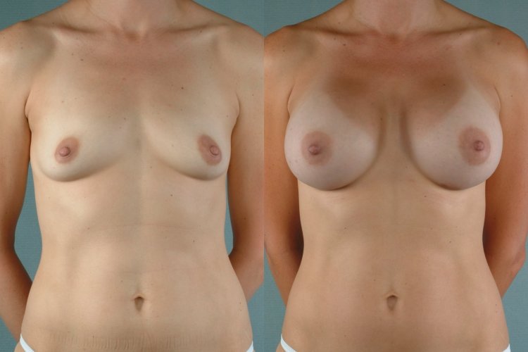 Breast enlargement