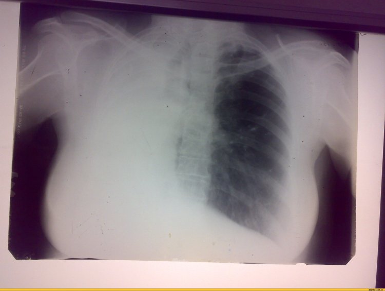 X -ray lungs